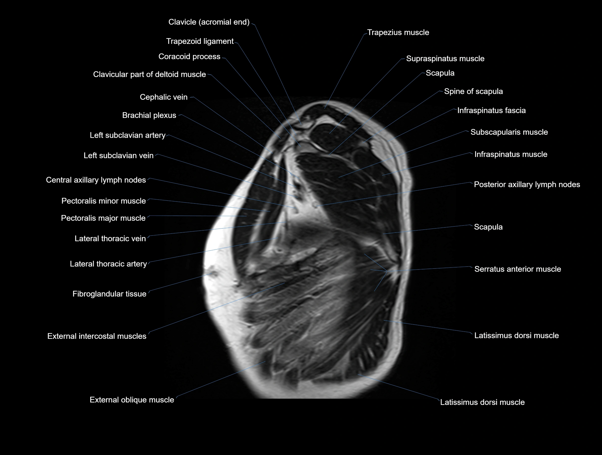 MRI chest (thorax) coronal  cross sectional anatomy 3T radiology  image-img-00001-00034.webp